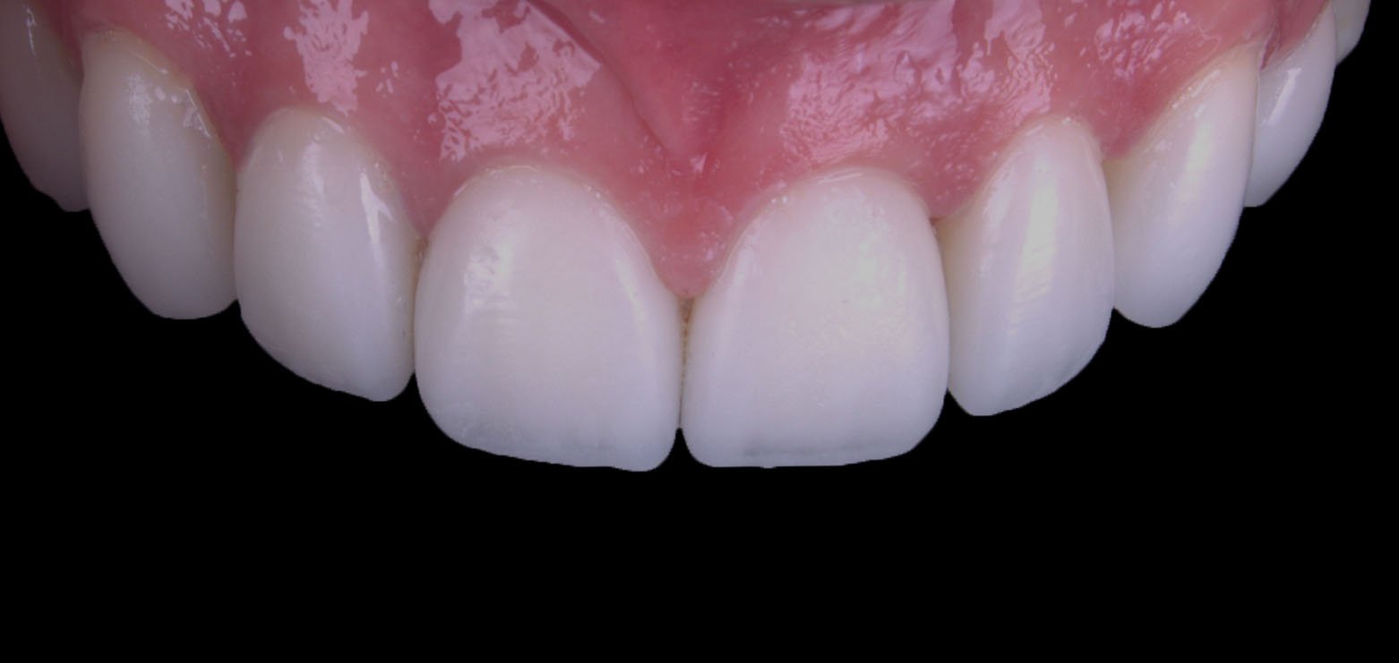 Caso 5 - Antes y Después