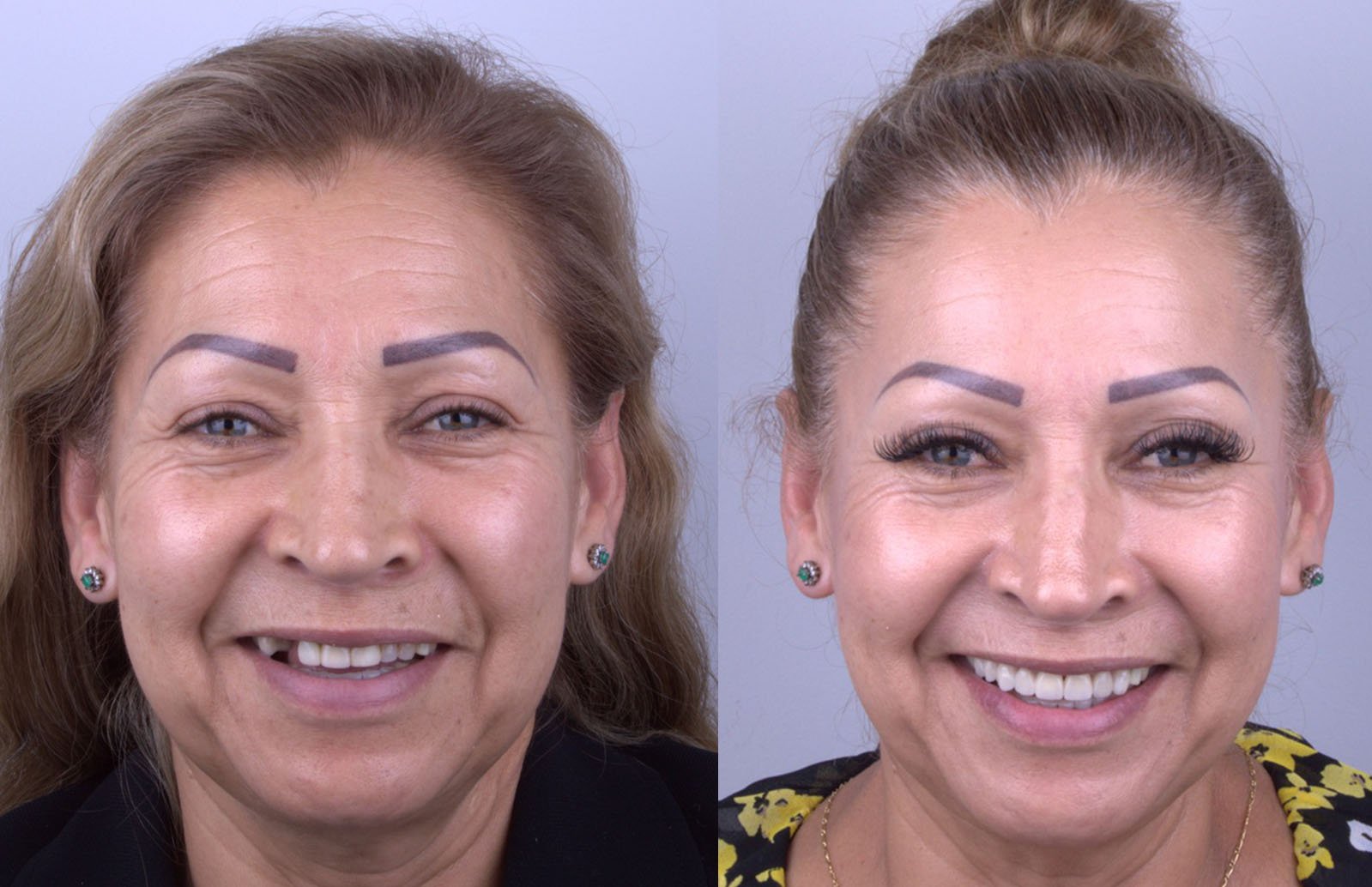 Caso 6 - Antes y Después