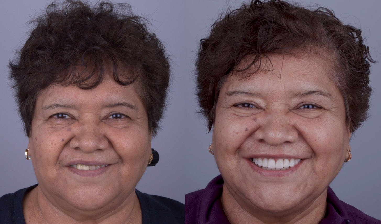 Caso 9 - Antes y Después